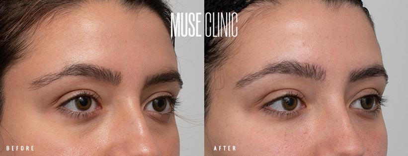 Dermal Filler Under Eye Patient BA 01 Dermal fillers under eye, before and after 01, Muse Clinic Sydney