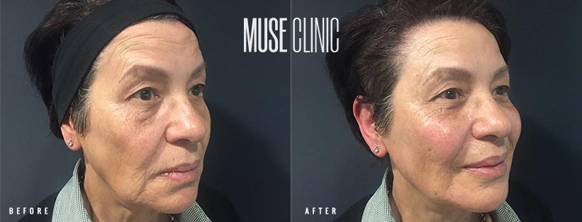 Liquid Facelift Dermal Fillers Patient BA 02-3 Non-Surgical Liquid Facelift with dermal fillers 02-2, female patient before & after treatment