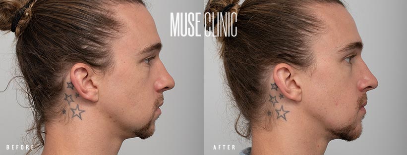 Dermal Fillers for Chin Patient BA 03-2 Recessed chin correction, before and after 03-2