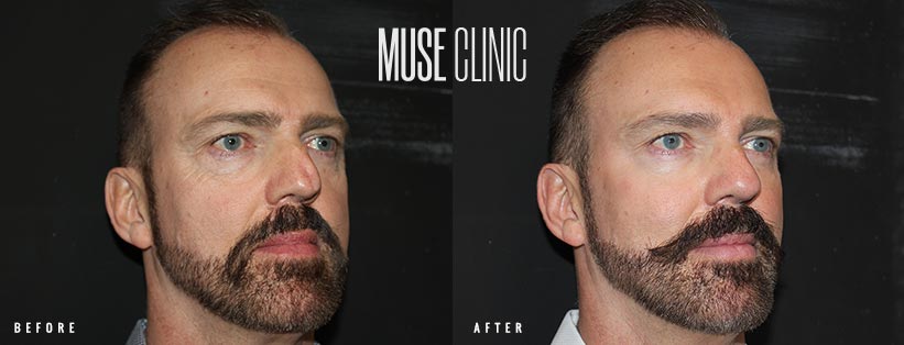 Face Rejuvenation and Dermal Fillers v2 Mid face and nose rejuvenation, before and after, Muse Clinic