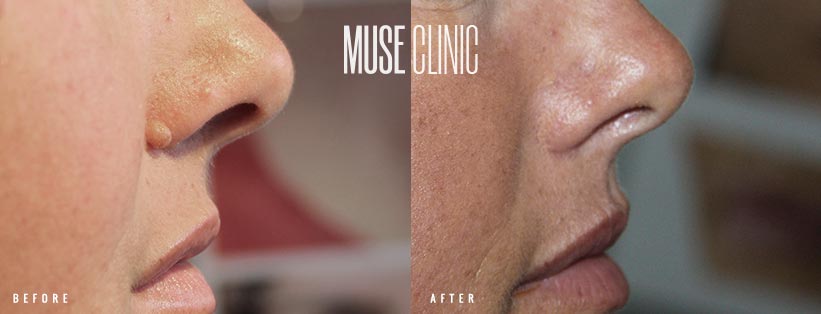 Mole Removal BA 02 MUSE Clinic Mole removal before and after 02, MUSE Clinic