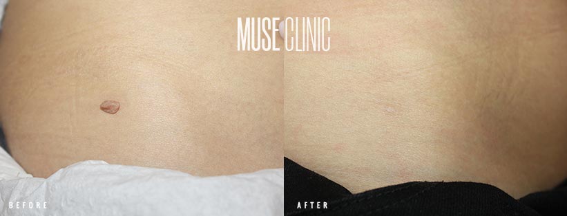 Mole Removal BA 04 MUSE Clinic Mole removal before and after 04, MUSE Clinic Sydney