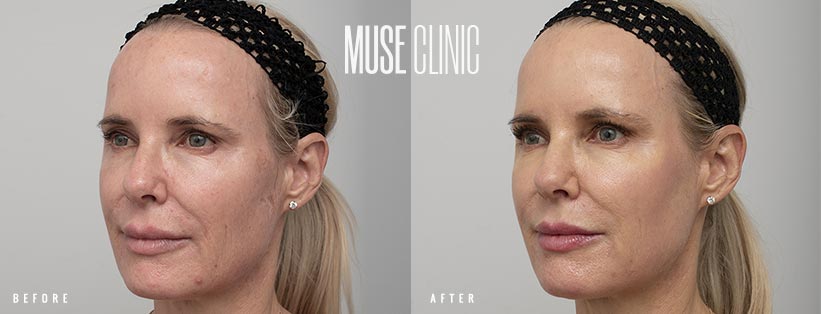 Pearl Laser 03-2 BA MUSE Clinic Full face resurfacing with Pearl fractional laser 03-2, MUSE Clinic Sydney