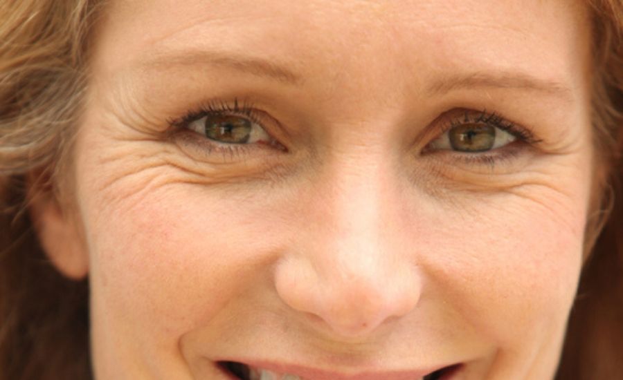 Anti-wrinkle treatment for crow's feet, MUSE Clinic Sydney