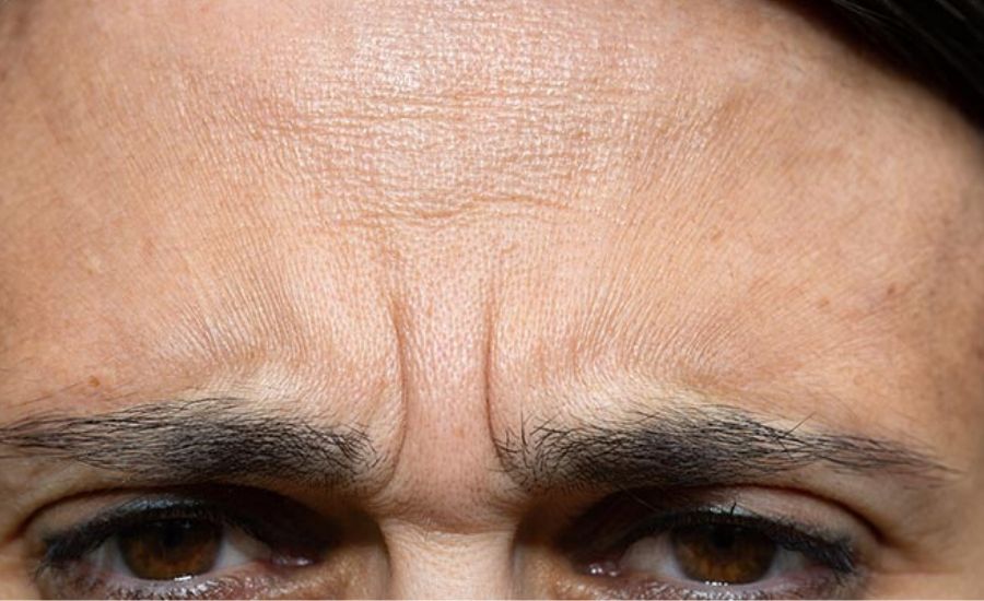 Anti-wrinkle injections for frown lines 01, MUSE Clinic Chatswood
