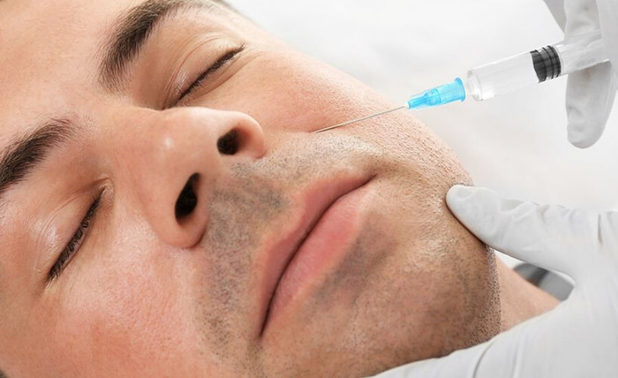 Nasolabial folds treatment at MUSE Clinic Chatswood, male patient