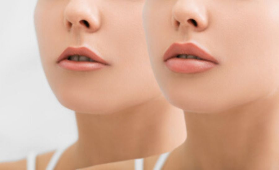 Lips before and after lip injections 01, Muse Clinic