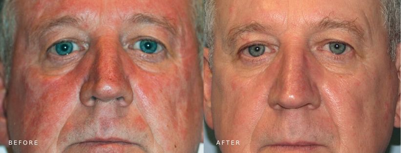 BBL (post 2tx) Male Patient Before and After BBL (post 2tx), male patient before and after treatment