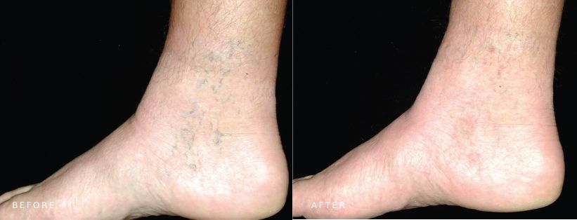 ClearV Ankles Vein Removal BA 03 MUSE Clinic ClearV laser vein removal from ankles 03, before and after, MUSE Clinic Sydney
