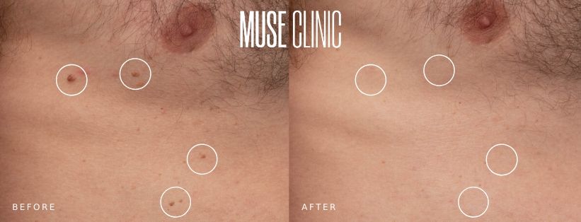 Cosmetic Mole Removal BA 03 Cosmetic mole removal (RF), before and after 03