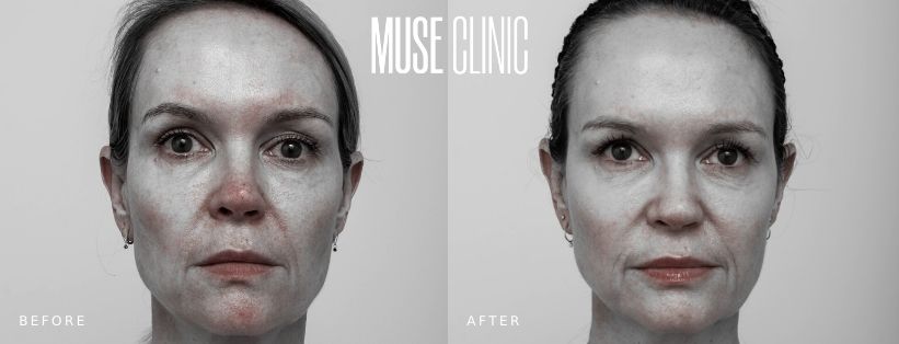 IPL Reduced Redness BA 01 Reduced redness (vascular filtered image), before and after