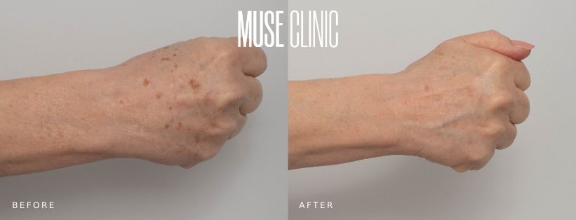 IPL hands Before and After IPL spot treatment, MUSE Clinic Sydney, before and afters