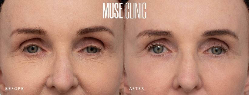 Pearl Under Eye Resurfacing BA 02 Under eye resurfacing, Pearl fractional laser, before and after 02