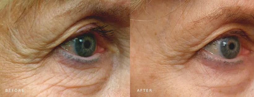 Pelleve Crows Feet MUSE Clinic Before After Pelleve under eye skin tightening, treatment results