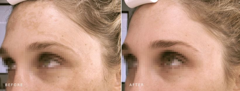 Ultraceuticals Brightening Accelerator Mask MUSE Clinic BA Ultraceuticals Brightening Accelerator Mask (6 mths), before and after