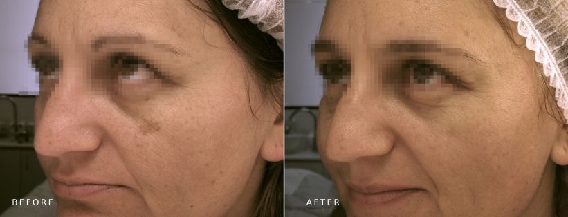 Ultraceuticals Brightening Accelerator Mask Ultraceuticals Brightening Accelerator Mask (14 weeks post)
