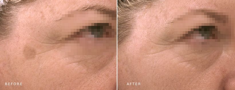 Ultraceuticals Brightening Serum Before After Ultraceuticals Brightening Serum (6 mths), before and afters