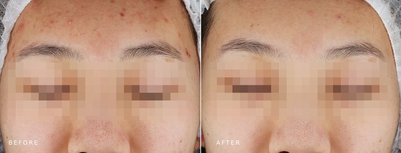 Ultraceuticals Clear Range MUSE Clinic Results Ultraceuticals Clear Range (3mth), treatment results