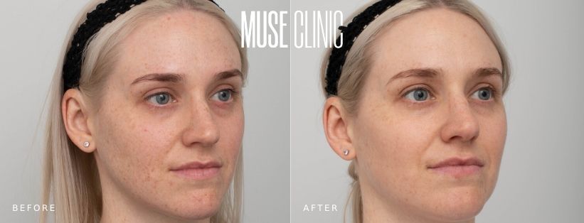 IPL pigmentation treatment IPL treatment for pigmentation