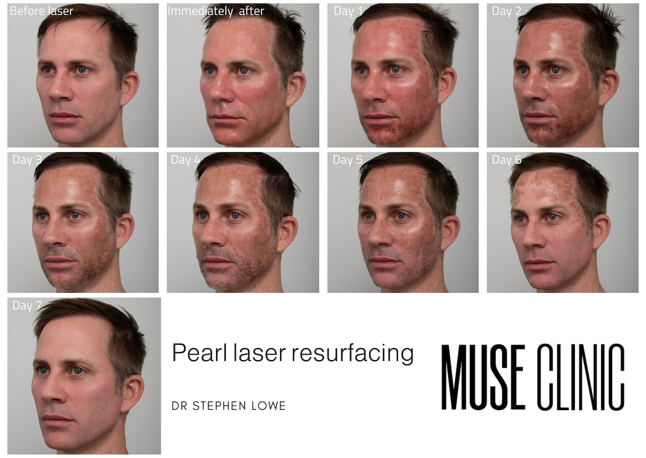 Laser Skin Resurfacing 2 - MUSE Clinic Laser resurfacing day by day