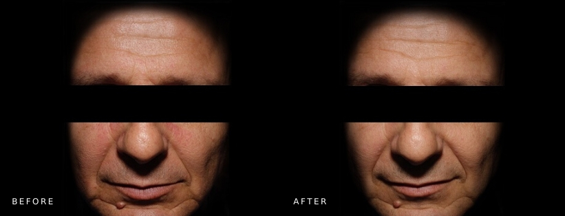 Reduced redness of think skin day 1-13 Skin redness day 1 - day 13