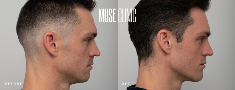 Jawline Definition Using Dermal Fillers BA 01 Dermal fillers for jawline definition, male patient before and after 01