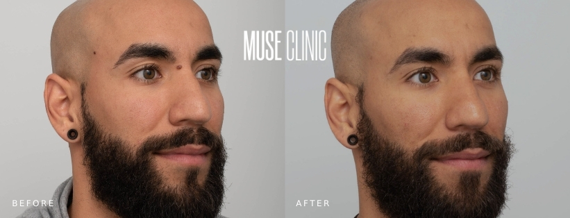 Cosmetic Mole Removal Before After 02 Cosmetic mole removal before and after 02, MUSE Clinic Sydney