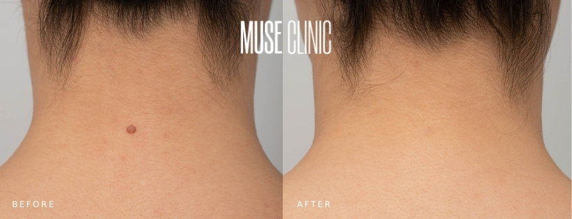 Scarless Mole Removal BA 01 No Scar Mole Removal, MUSE Clinic, before and after 01