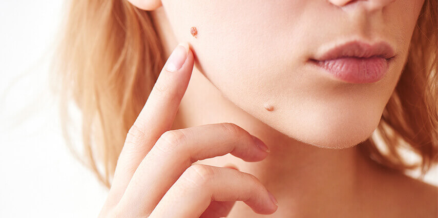 RF Mole Removal Model 02 RF cosmetic mole removal in Sydney, model 02