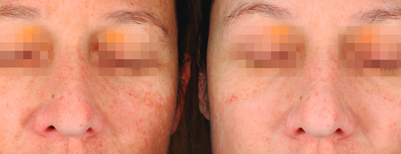 Dermamelan Treatment Patient Before and After 04 Dermamelan treatment before and after 04, Dr Lowe Sydney