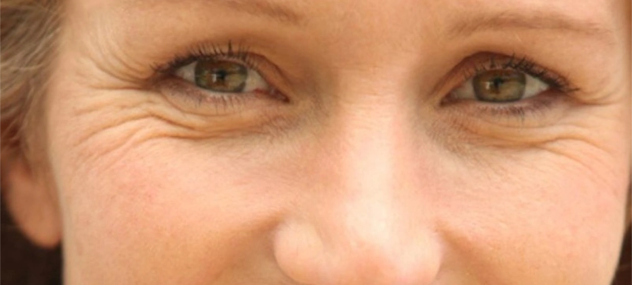 Skin problems in perimenopause